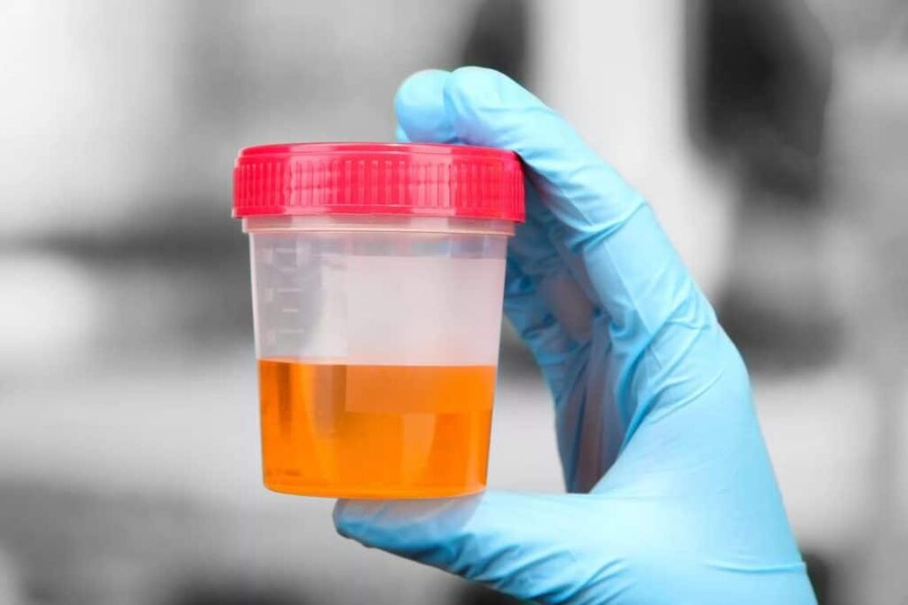 Urine with blood in calcareous prostatitis